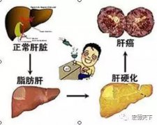 千万别小看“脂肪肝”